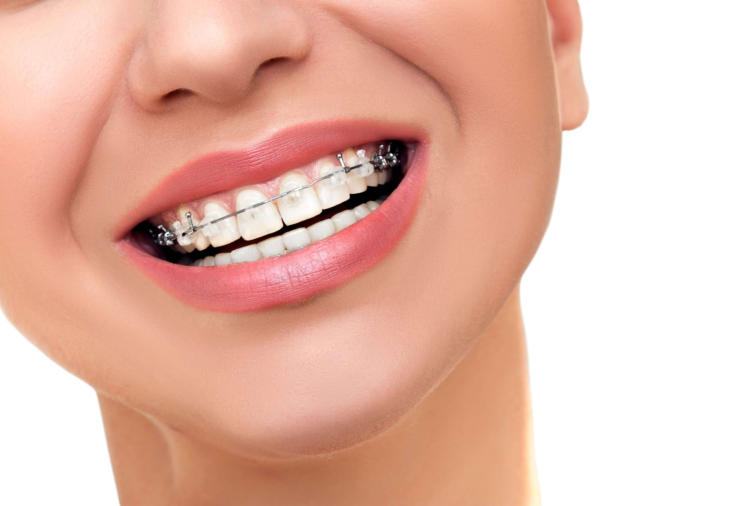 Choosing the Right Miami Dental Braces