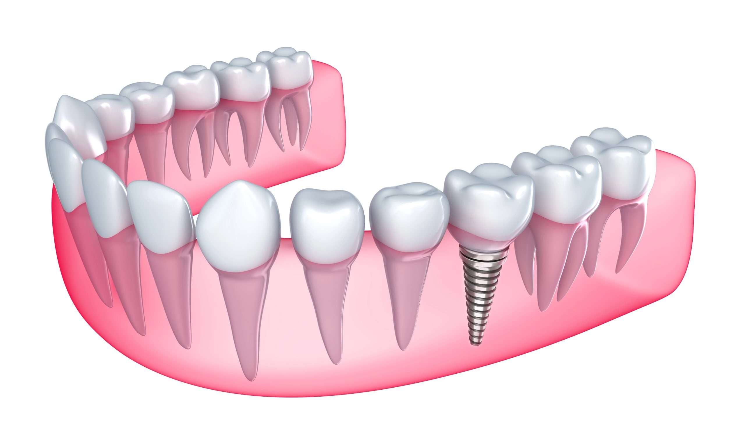 Dental Implants in Miami, FL - Dr. Patty Miami Cosmetic Dentistry | Call 305-735-3002