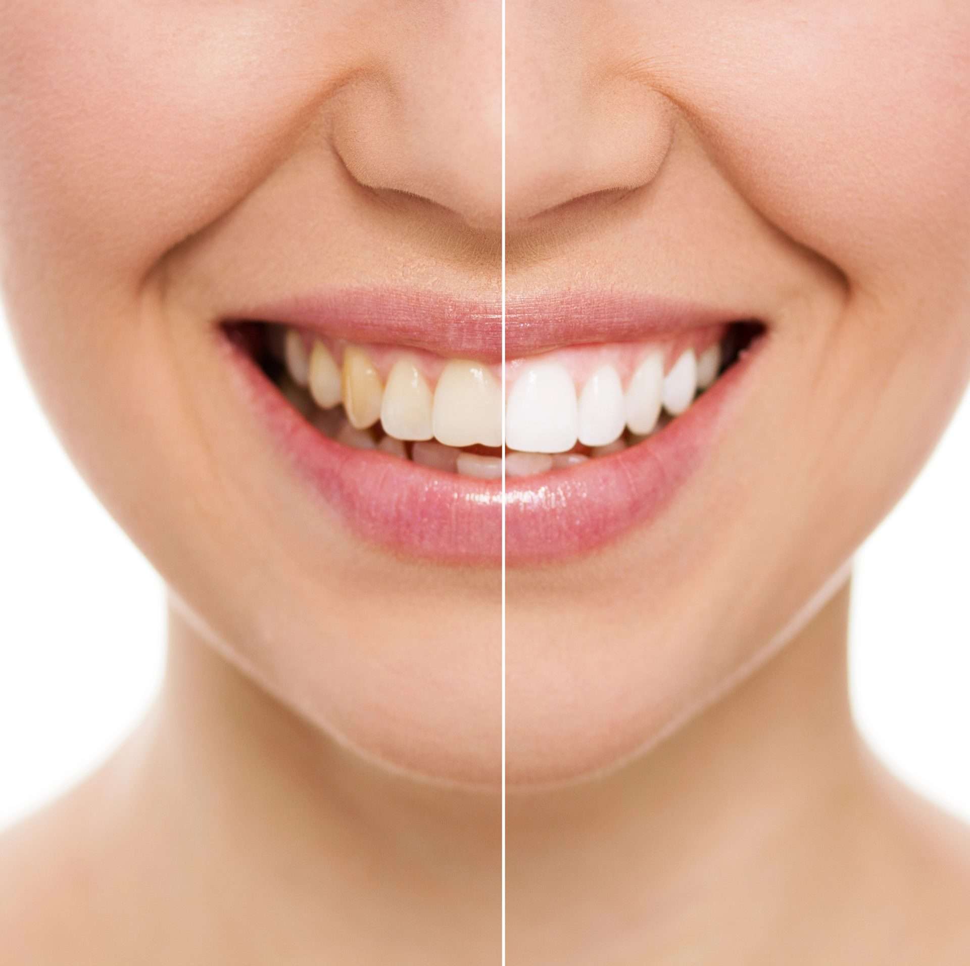 Internal Bleaching Service in Miami, FL | Dr. Patty Miami Cosmetic Dentistry | 305-735-3002