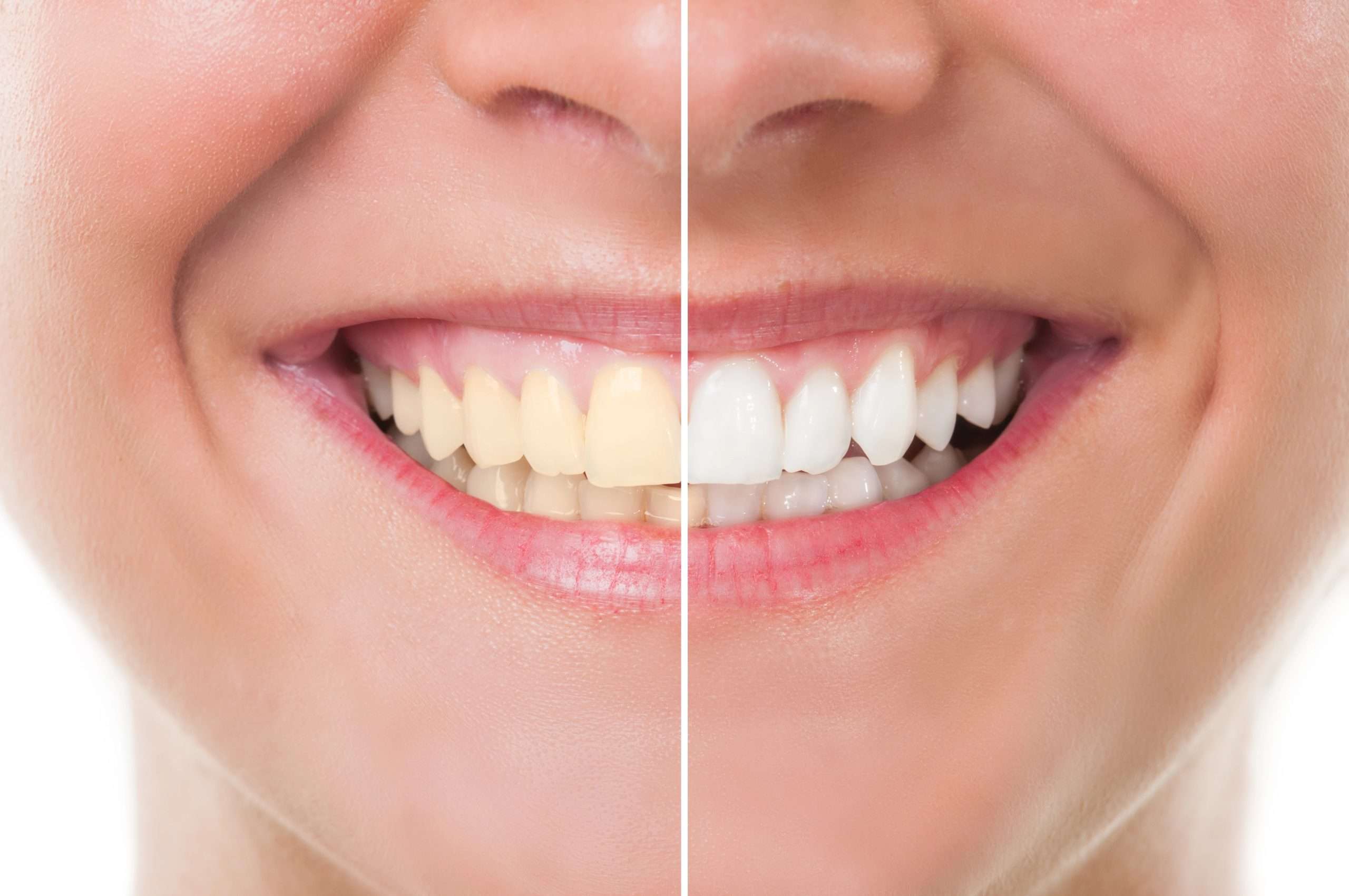 Teeth whitening for coffee stains What you need to know