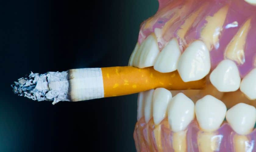 Teeth whitening for smokers Best practices and tips