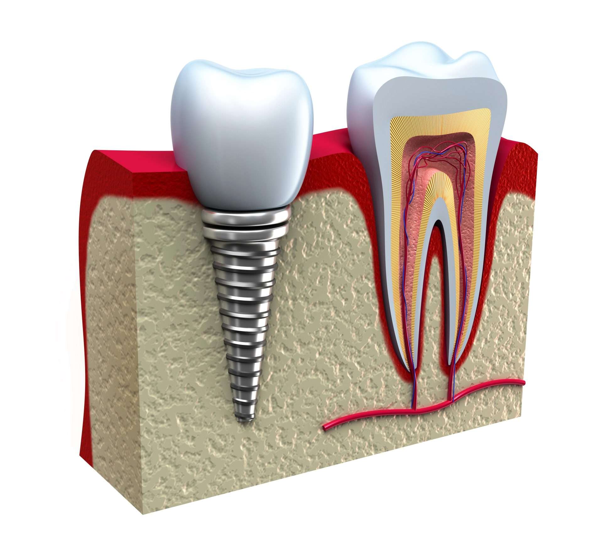 Traumatic Injuries Treatment in Miami, FL - Dr. Patty Miami Cosmetic Dentistry