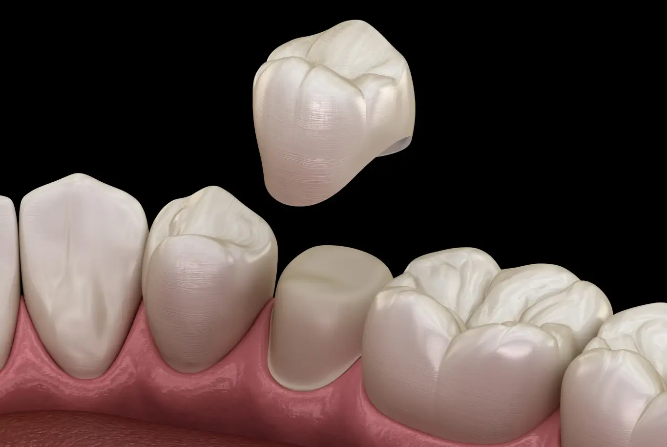 Miami Dental Crowns | Miami Cosmetic Dentistry | Call (786) 841-8482